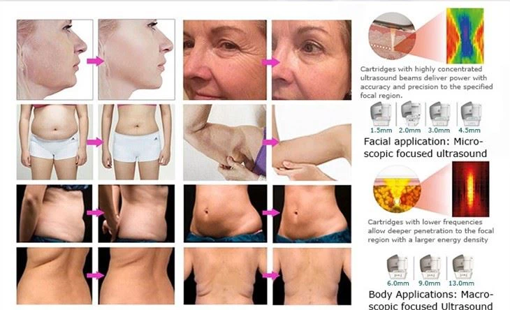 HIFU Facelift Machine- Macro & Micro High Energy Focused Ultrasound System